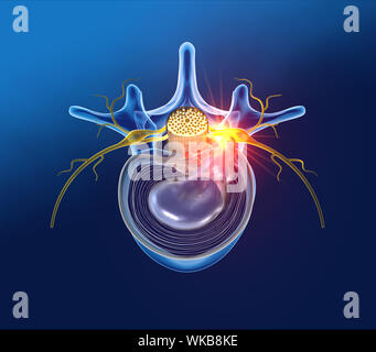 Hernie discale douloureuse, vertèbre lombaire, médicalement 3D illustration sur fond bleu Banque D'Images