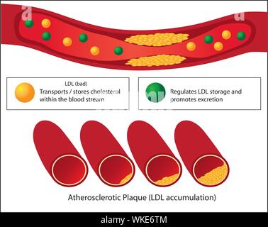 Rôle des bons et mauvais lipides et niveaux de plaque athérosclérotique de vaisseau sanguin vecteur médicale infographie Illustration de Vecteur