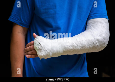 Homme avec bras cassé enveloppé medical cast plâtre. Plâtre en fibre de verre couvrant le poignet, le bras, le coude après un accident de sport, isolé sur fond noir Banque D'Images