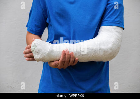 Homme avec bras cassé enveloppé medical cast plâtre. Plâtre en fibre de verre couvrant le poignet, le bras, le coude après un accident de sport, isolated on white Banque D'Images