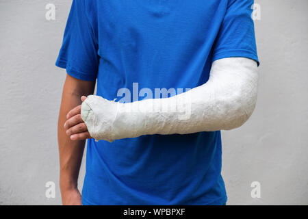 Homme avec bras cassé enveloppé medical cast plâtre. Plâtre en fibre de verre couvrant le poignet, le bras, le coude après un accident de sport, isolated on white Banque D'Images