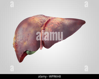Iillustration de malades atteints de cancer du foie humain isolé Banque D'Images