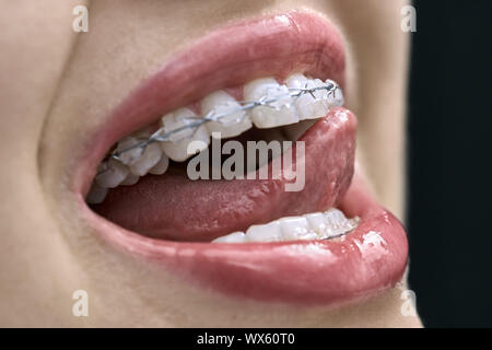 Belle jeune fille passe sa langue sur les dents à l'aide d'accolades dans une clinique dentaire. Horizontal macro photo. Banque D'Images