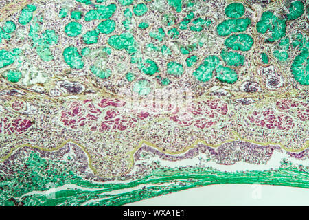 Le tissu pulmonaire Asthme sous le microscope 100x Banque D'Images