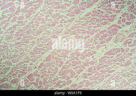 Infarctus du myocarde de tissus malades sous le microscope 200x Banque D'Images