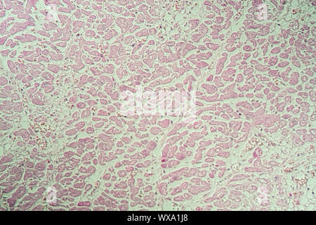 Infarctus du myocarde de tissus malades sous le microscope 200x Banque D'Images