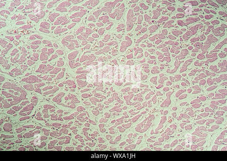 Infarctus du myocarde de tissus malades sous le microscope 200x Banque D'Images