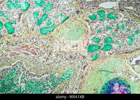 Le tissu pulmonaire Asthme sous le microscope 100x Banque D'Images