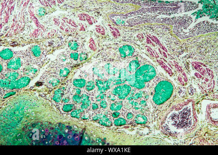 Le tissu pulmonaire Asthme sous le microscope 100x Banque D'Images