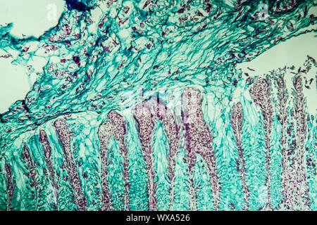 Cancer du côlon adénocarcinome 100x Banque D'Images