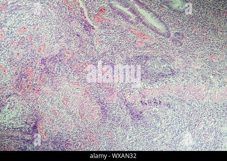 La maladie de Crohn, l'inflammation intestinale sous le microscope 100x Banque D'Images