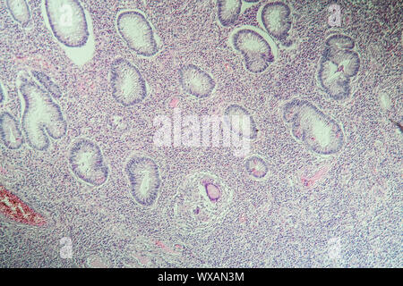 La maladie de Crohn, l'inflammation intestinale sous le microscope 100x Banque D'Images