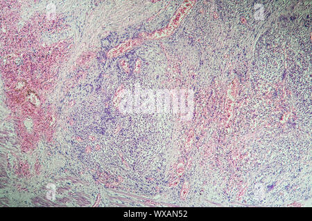 La maladie de Crohn, l'inflammation intestinale sous le microscope 100x Banque D'Images
