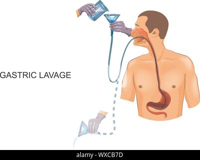 Vector illustration d'un lavage gastrique avec un tube gastrique Illustration de Vecteur