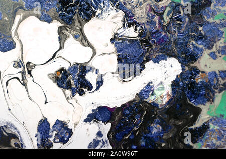 Scarsamente differenziato adenocarcinoma intestinale, micrografia di luce, foto al microscopio Foto Stock