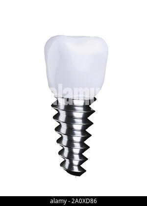 Dente dentale impianto. Isolato su sfondo bianco 3d rendering immagine Foto Stock