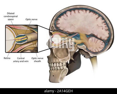 Concetto medico mostra il rigonfiamento del nervo ottico causata da un aumento della pressione intracranica. Foto Stock