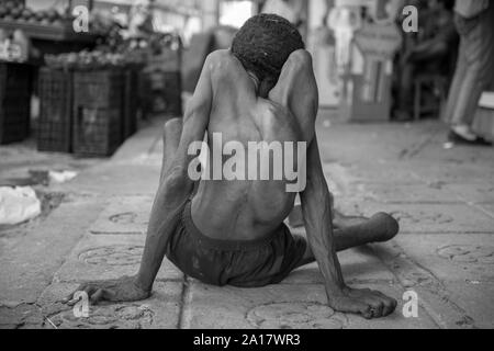 Uomo senza tetto con malattia congenita rivolta verso la vita delle strade Foto Stock