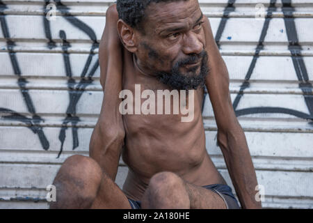 Uomo senza tetto con malattia congenita del marciapiede guardando lontano Foto Stock