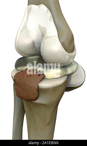 Ginocchio umano, ginocchio, rendering 3d'illustrazione del ginocchio, dolore illustrazione lato del ginocchio, ginocchio x-ray, ginocchio umano malattia Foto Stock