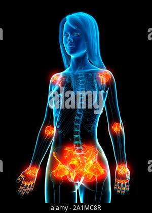 Legamenti infiammati, concettuale illustrazione del computer Foto Stock