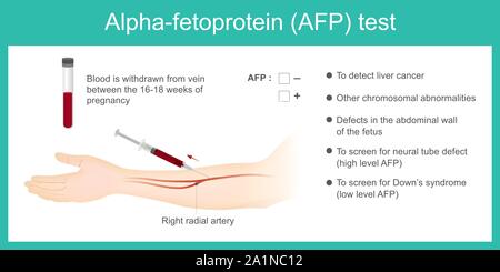 Alfa-fetoproteina test AFP. Utilizzare l'analisi mediante AFP. di livello per rilevare il cancro al fegato, e l'uso di schermo per la sindrome di down. Illustrazione Vettoriale