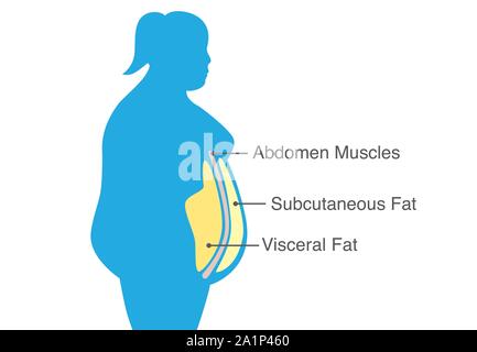 Il grasso viscerale e del grasso sottocutaneo che si accumulano intorno al girovita di donna. Illustrazione Vettoriale