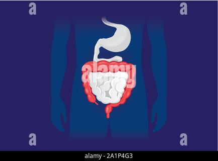 Illustrazione circa sintomo anormale di umana intestino crasso. Illustrazione Vettoriale