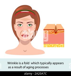 Infografico illustrazione della pelle. Ruga, cambiamento del volto, vettore Illustrazione Vettoriale