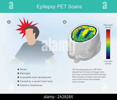 Epilessia scansioni PET. Le cellule cerebrali se commozione cerebrale o epilessia malattia, causare il cervello di malfunzionamento, anormalità può essere rilevato imaging utilizzando Illustrazione Vettoriale