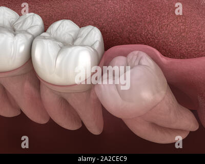 Denti sani e dente di saggezza con impatto mediale . Accurata dal punto di vista medico dente 3D illustrazione Foto Stock