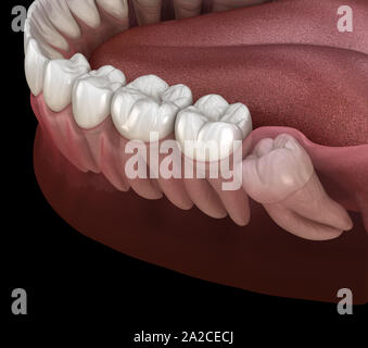 Denti sani e dente di saggezza con impatto mediale . Accurata dal punto di vista medico dente 3D illustrazione Foto Stock