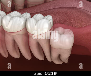 Denti sani e dente di saggezza con impatto verticale . Accurata dal punto di vista medico dente 3D illustrazione Foto Stock