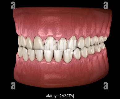 Underbite occlusione dentale ( malocclusioni di denti ). Accurata dal punto di vista medico dente 3D illustrazione Foto Stock