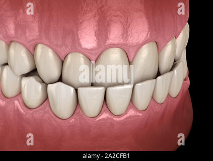Underbite occlusione dentale ( malocclusioni di denti ). Accurata dal punto di vista medico dente 3D illustrazione Foto Stock