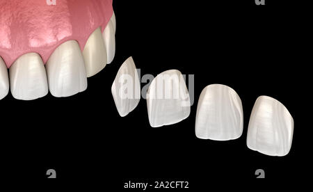 Impiallacciatura di procedura di installazione più incisivo centrale e incisivo laterale. Accurata dal punto di vista medico dente 3D illustrazione Foto Stock