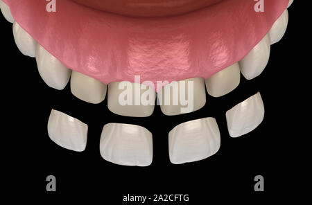 Impiallacciatura di procedura di installazione più incisivo centrale e incisivo laterale. Accurata dal punto di vista medico dente 3D illustrazione Foto Stock