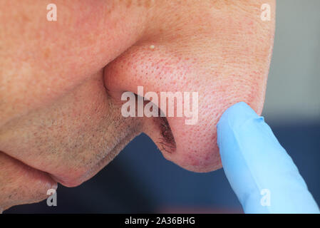 Chiudere l'uomo faccia con whitehead brufoli sul naso, acne malattia. Foto Stock