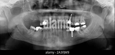 Panoramica di radiografia dentale Foto Stock
