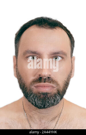 Un uomo con lo strabismo. Orthoptics. oftalmologia concetto. Medical malattia. Foto Stock
