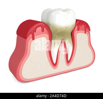 3D render del dente in gengive sanguinanti su sfondo bianco. La malattia periodontale concetto. Foto Stock