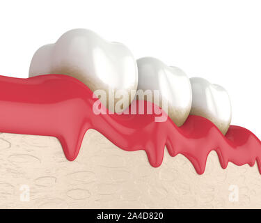 3D render di denti nelle gengive sanguinanti su sfondo bianco. La malattia periodontale concetto. Foto Stock