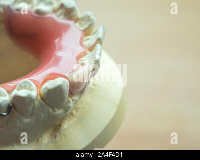 Dente dentale protesi Foto Stock