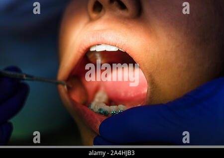 Dentista esaminando un pazienti denti per i dentisti sedia sotto una luce brillante presso la clinica dentale Foto Stock