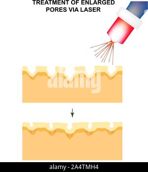 Pori allargata. La struttura della pelle. Rughe, acne cicatrice. Il restringimento dei pori da un laser. Infographics. Illustrazione Vettoriale sulla isolato Illustrazione Vettoriale