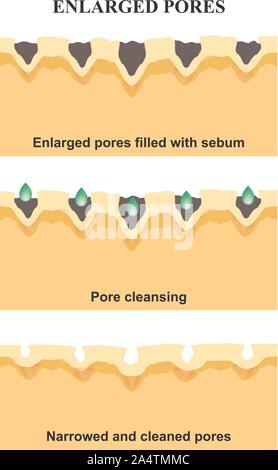 Pori allargata. La struttura della pelle. Rughe, acne cicatrice. Pulizia e restringendo i pori. Infographics. Illustrazione Vettoriale sulla isolato Illustrazione Vettoriale