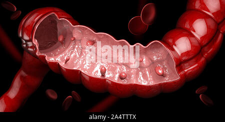 3d illustrazione dei polipi colon. Polipo nell'intestino isolato nero Foto Stock