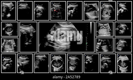 Raccolta di immagini di scansione a ultrasuoni l'esame. Feto in 7 mese Foto Stock