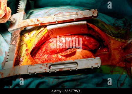Cuore umano vicino a torace aperto durante la chirurgia della camera operativa Foto Stock