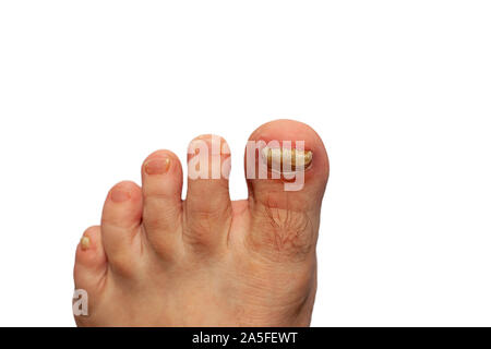 Il fungo della toenails. Toenails distrutti. Toenail piastra è influenzata da fungo. Le piastre delle unghie delle dita dei piedi sono sfigurato. Isolato. Foto Stock